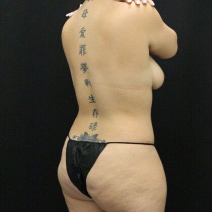 Liposuction: Case 42 - After