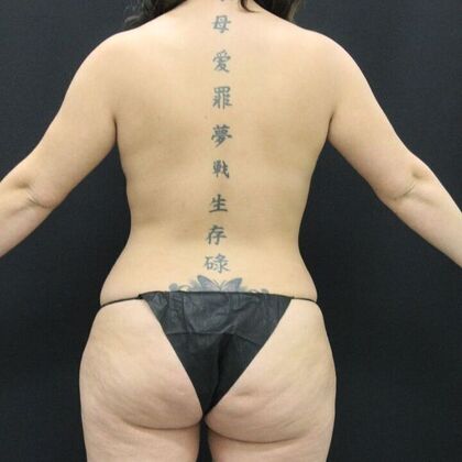 Liposuction Case 42 - Before