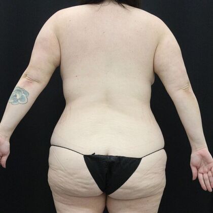 Liposuction Case 43 - Before