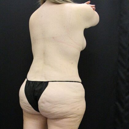 Liposuction: Case 43 - After