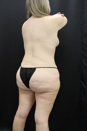 Tummy Tuck: Case 49 - Before