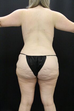 Tummy Tuck: Case 49 - After