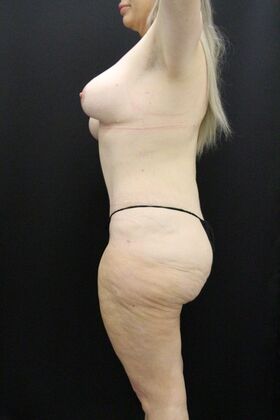 Tummy Tuck: Case 49 - After