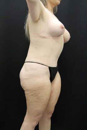 Tummy Tuck: Case 49 - After