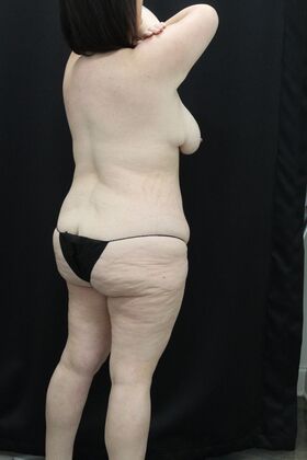 Tummy Tuck: Case 49 - Before