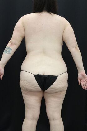 Tummy Tuck: Case 49 - Before