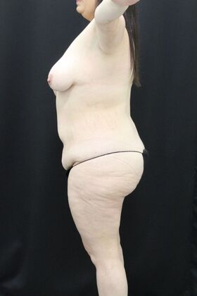 Tummy Tuck: Case 49 - Before