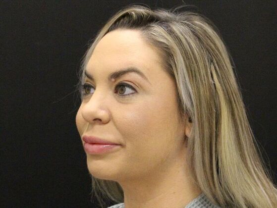 Liposuction: Case 44 - After