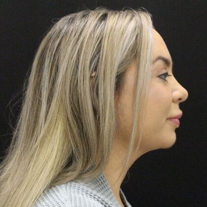 Liposuction: Case 44 - After