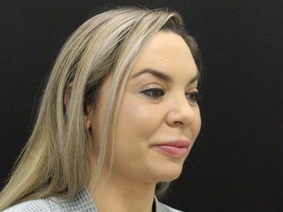 Liposuction: Case 44 - After