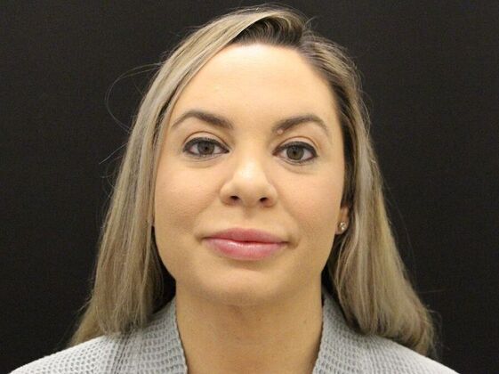 Liposuction: Case 44 - After