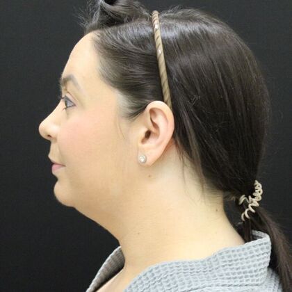 Liposuction Case 44 - Before