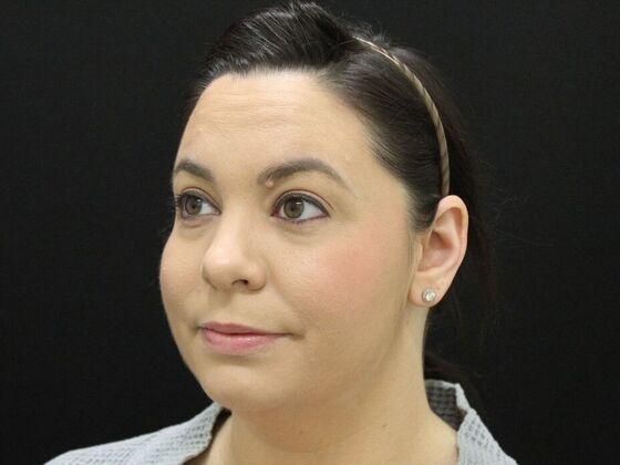 Liposuction: Case 44 - Before