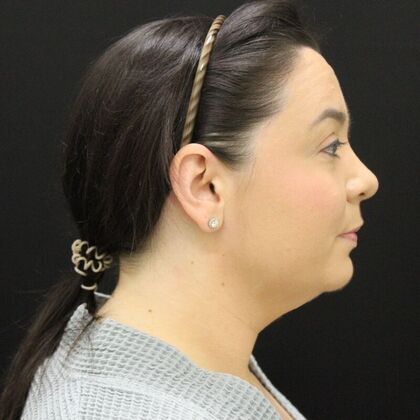 Liposuction: Case 44 - Before