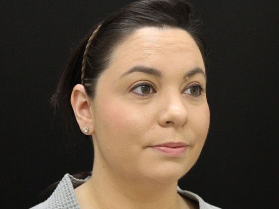 Liposuction: Case 44 - Before