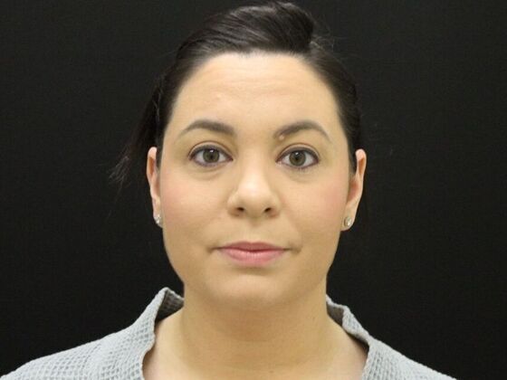 Liposuction: Case 44 - Before