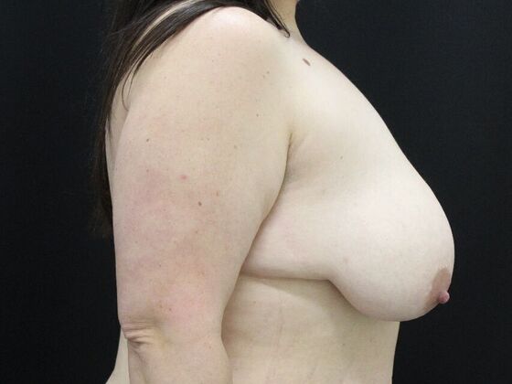 Breast Reduction & Lift: Case 20 - Before