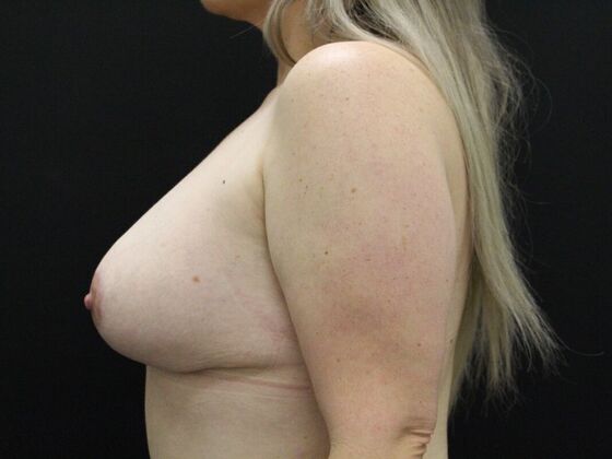 Breast Reduction & Lift: Case 20 - After