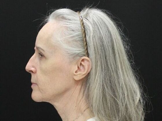 Face & Neck Lifts: Case 3 - Before