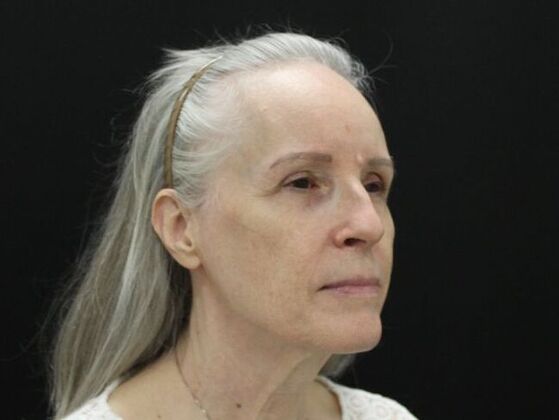 Face & Neck Lifts Case 3 - Before