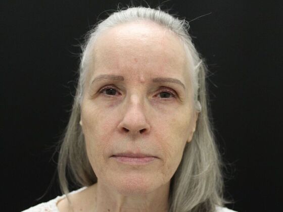 Face & Neck Lifts: Case 3 - Before