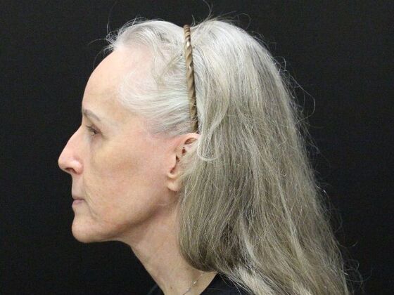 Face & Neck Lifts: Case 3 - After