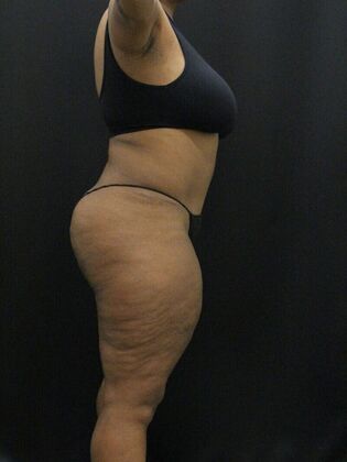 Tummy Tuck: Case 50 - After