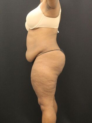 Tummy Tuck: Case 50 - Before