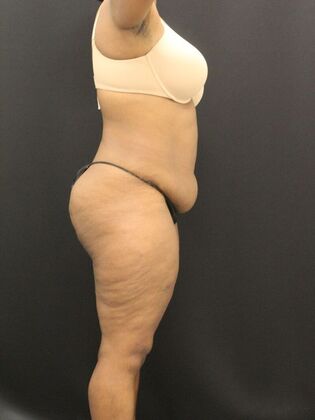 Tummy Tuck: Case 50 - Before