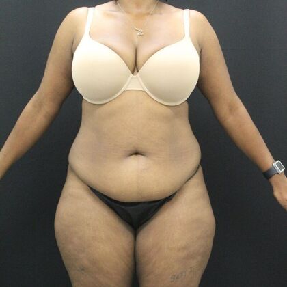 Tummy Tuck Case 50 - Before