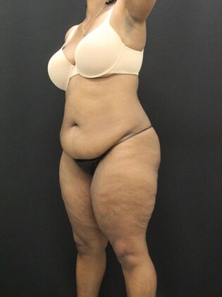 Tummy Tuck: Case 50 - Before