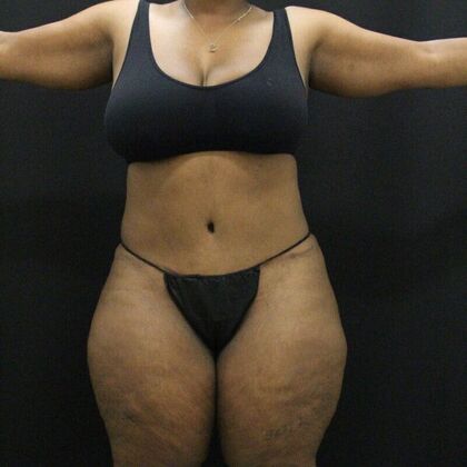 Tummy Tuck Case 50 - After