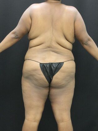 Tummy Tuck: Case 51 - Before