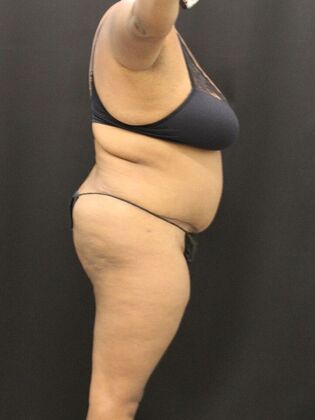 Tummy Tuck: Case 51 - After