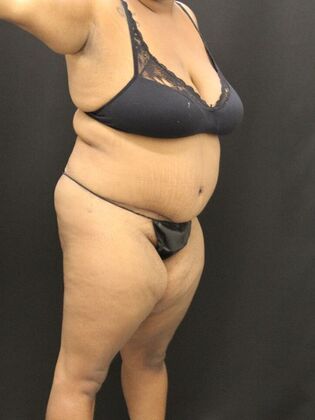 Tummy Tuck: Case 51 - After