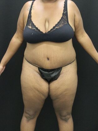 Tummy Tuck: Case 51 - After