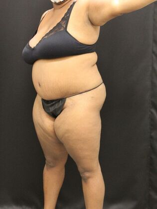 Tummy Tuck Case 51 - After