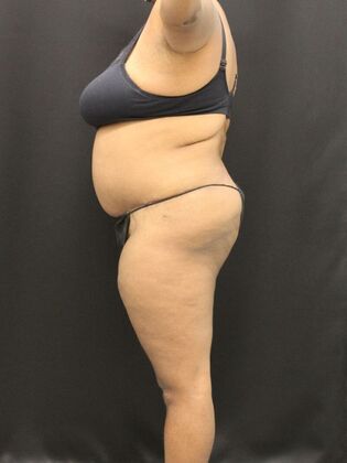 Tummy Tuck: Case 51 - After