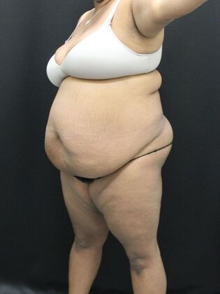 Tummy Tuck Case 51 - Before