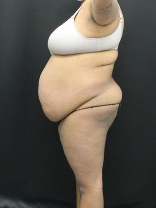 Tummy Tuck: Case 51 - Before