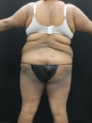 Tummy Tuck: Case 51 - Before