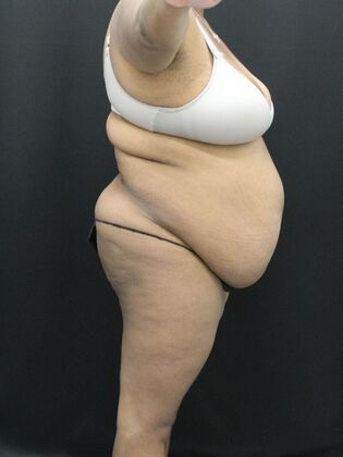 Tummy Tuck: Case 51 - Before