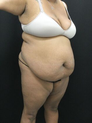 Tummy Tuck: Case 51 - Before