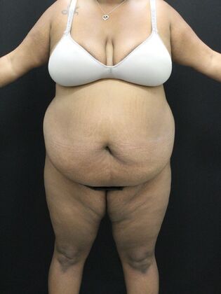 Tummy Tuck: Case 51 - Before