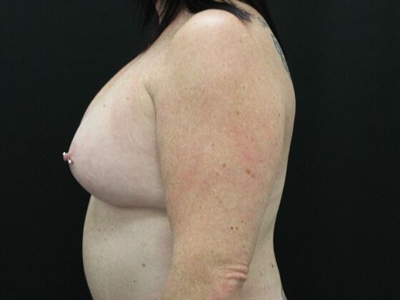 Breast Augmentation: Case 33 - After