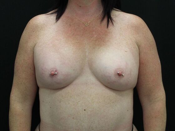 Breast Augmentation Case 33 - After