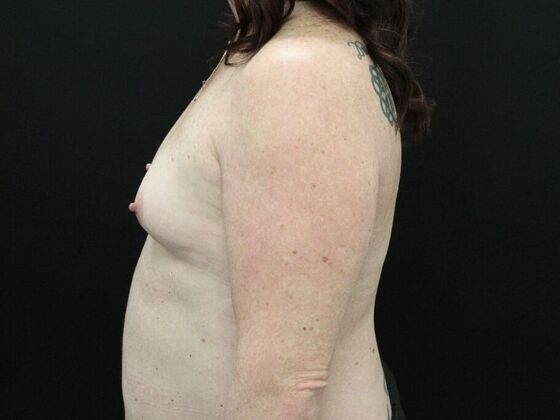 Breast Augmentation: Case 33 - Before
