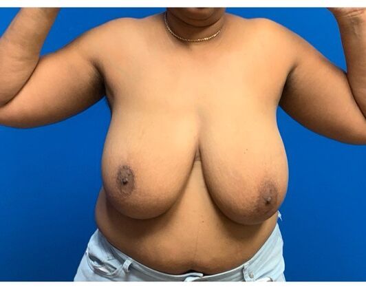 Breast Reduction Case 16 - Before