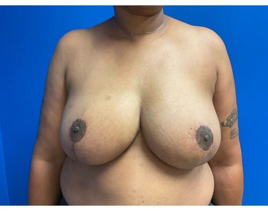 Breast Reduction Case 16 - After