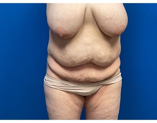 Abdominoplasty: Case 32 - Before